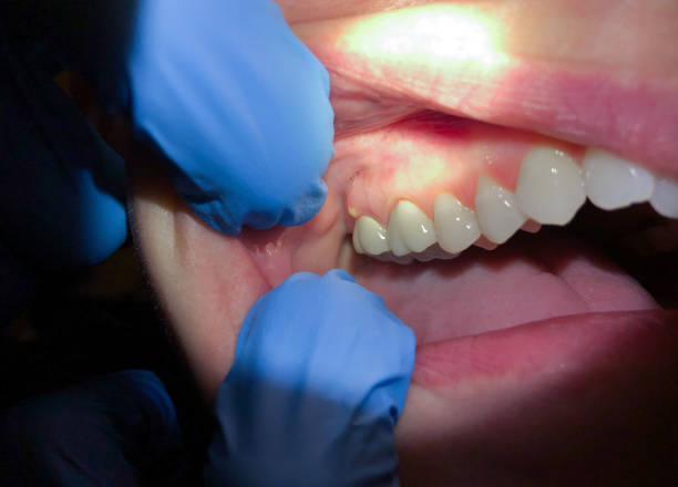 Best Emergency Treatment for Dental Infections or Abscesses in Rockwell Place, TX