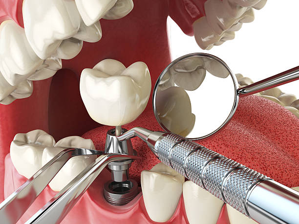 Best Emergency Wisdom Teeth Removal in Rockwell Place, TX